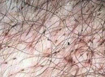 阴虱病的治疗的手法