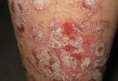 脸部银屑病伤害多吗