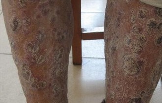 专治银屑病医院哪家好