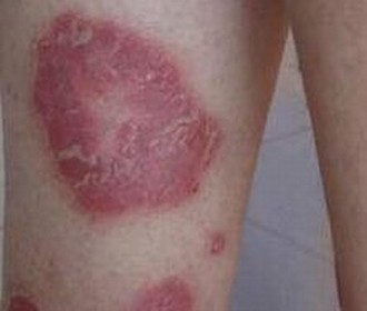 银屑病是否遗传或传染问题的权威解答