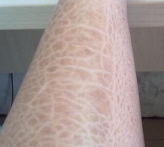 鱼鳞病如何护理才是正确的