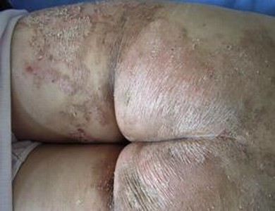 鱼鳞病造成的四大危害