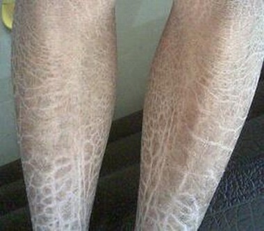 鱼鳞病预防如何做好