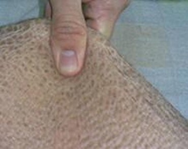 鱼鳞病用什么药治疗
