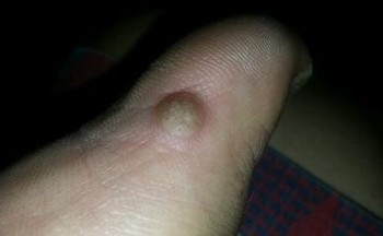 鸡眼是啥样的呢