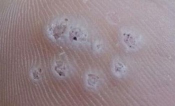 鸡眼是啥样子的