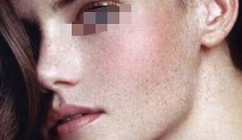 雀斑的危害严重吗，患者要如何做才能减轻呢