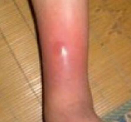 丹毒和急性蜂窝组织炎不一样之处