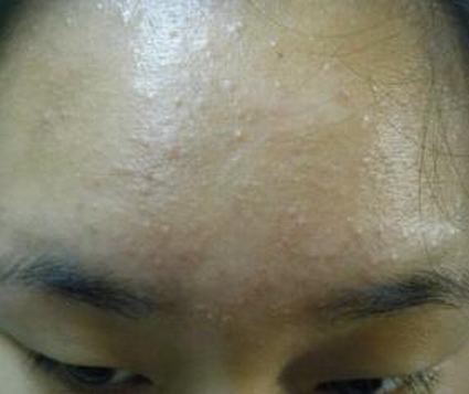 白色突起是粉刺 也或许是毛囊角化
