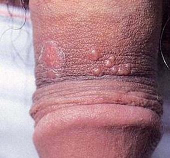 生殖器疱疹的病因