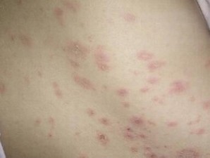 生活中怎样的预预防湿疹
