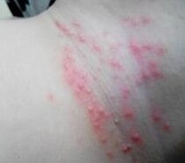 湿疹的正确医治方法
