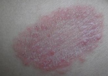 预防股癣有哪些措施