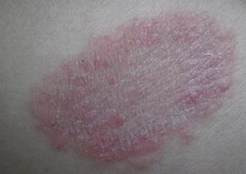 怎么有用预防体癣