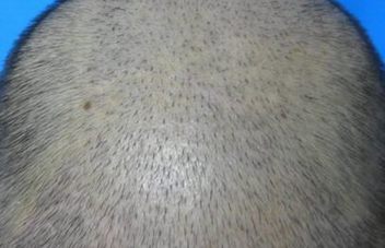 脱发到底该吃啥好