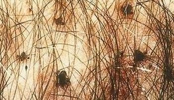 阴虱病怎样治疗呢好