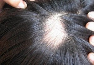 脱发的症状有一些什么类型