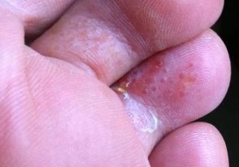 脚上长水泡很痒是否脚气