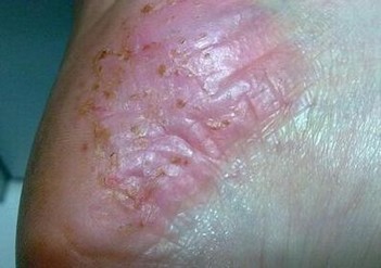 水疱型脚气 预防水疱型脚气 