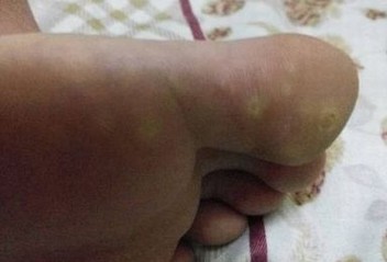 夏季脚气产生的病因有什么