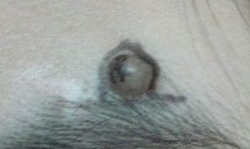 眼白结膜色素痣的症状