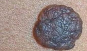 眼球结膜色素痣的特点