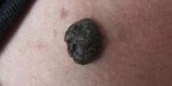 晕痣的发生特点及症状的辨别诊断