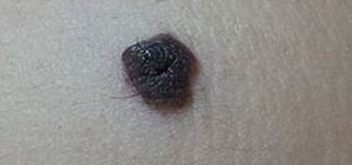 晕痣先天性色素痣的特征及表现