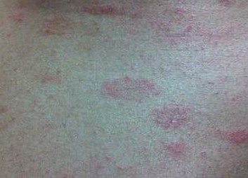如何有效护理体癣患者