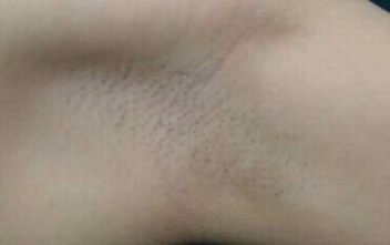 腋臭疾病的典型表现有啥呢