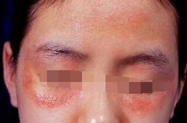 湿疹为何颠来倒去总是治不好