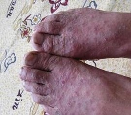 慢性湿疹如何进行治理