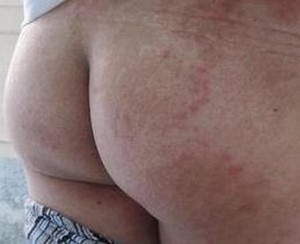 体股癣如何治疗