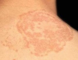 体股癣发病的季节性特点