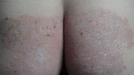 体股癣会给患者带来什么作用