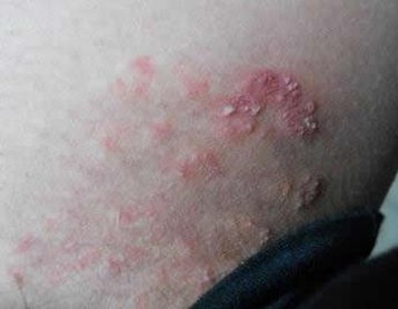 体股癣的症状全明了