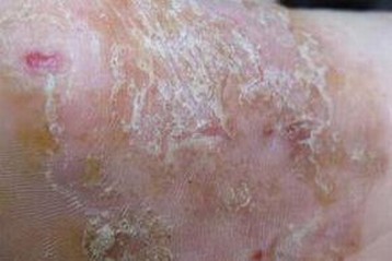 体股癣的治疗应该关注什么