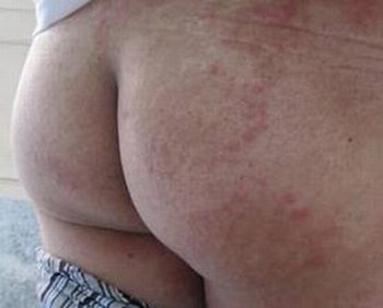 体股癣的临床体现有些啥
