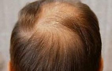 脱发的主要病因有什么