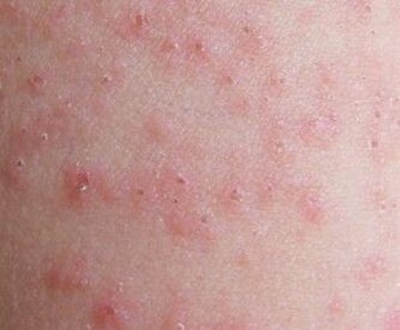 荨麻疹的是什么导致都包含什么呢