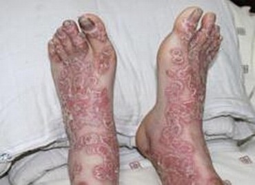 银屑病患者洗澡很重视