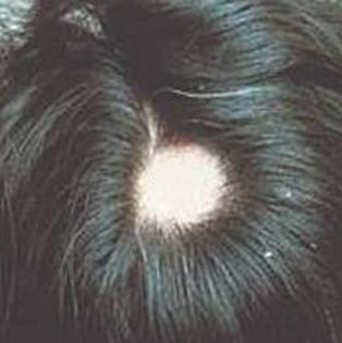 斑秃的发生因素首要有哪些_斑秃