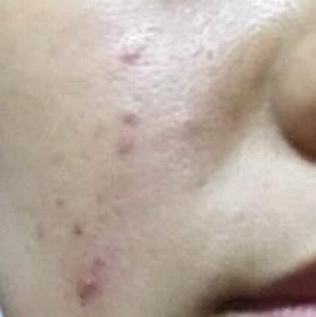 痤疮的常见类型及各自的症状 