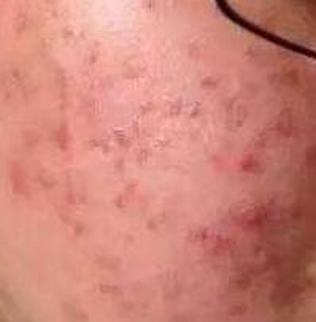 痤疮的常见体现是啥样的