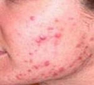 痤疮的典型临床体现有些啥