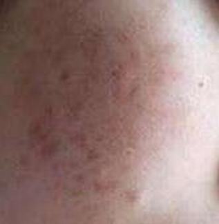 痤疮的家庭护理