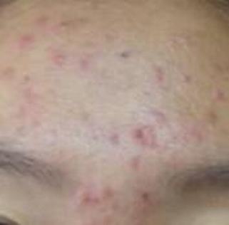 痤疮的治疗方法有哪些