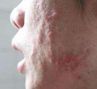 常常用温水洗脸能有用预防痤疮