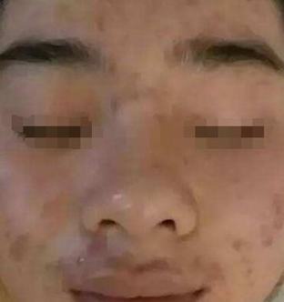 成年人长痤疮如何治疗