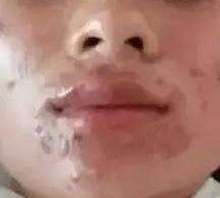 成人痤疮怎样的预防有效